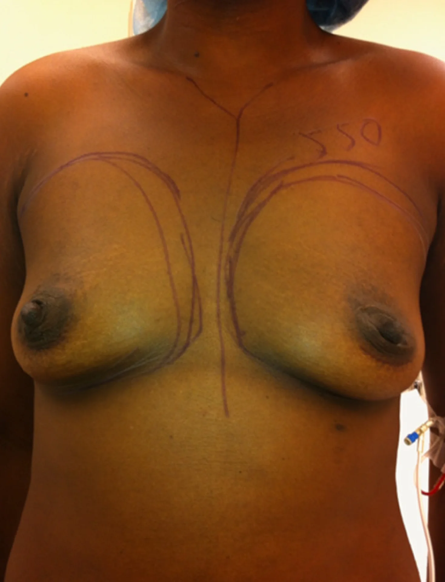 Understanding Breast Augmentation — Dr. Adelaida Blog