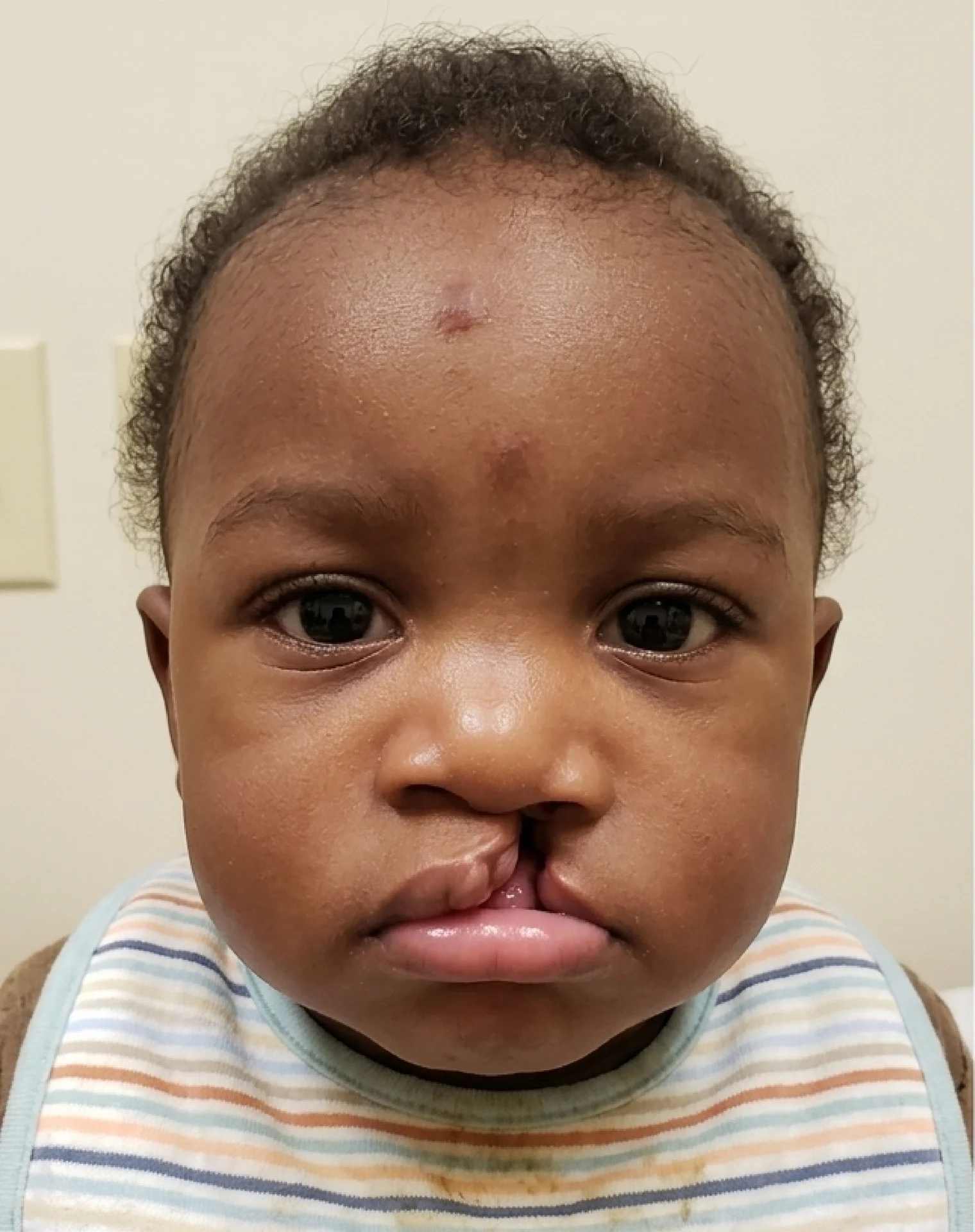 Before: Cleft lip Surgery — patient transformation results