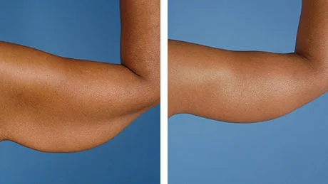 Arm Lift — plastic surgery procedure by Dr. Adelaida