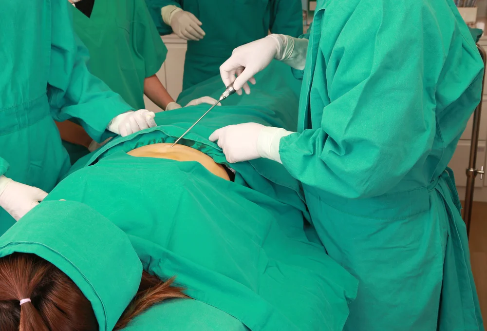 Liposuction — plastic surgery procedure by Dr. Adelaida