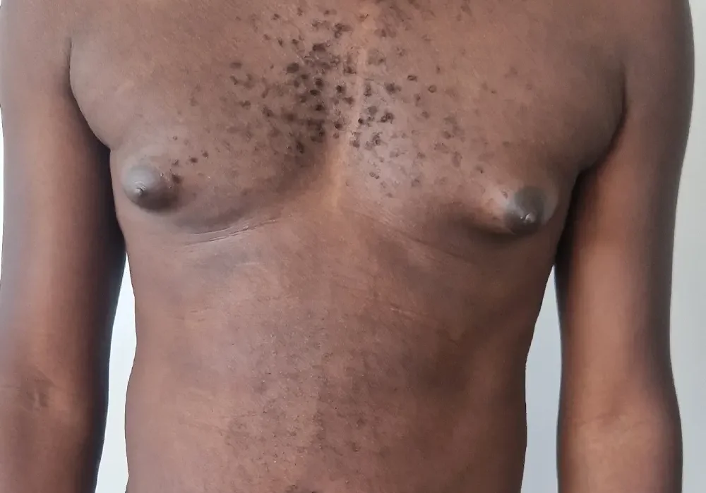 Breast